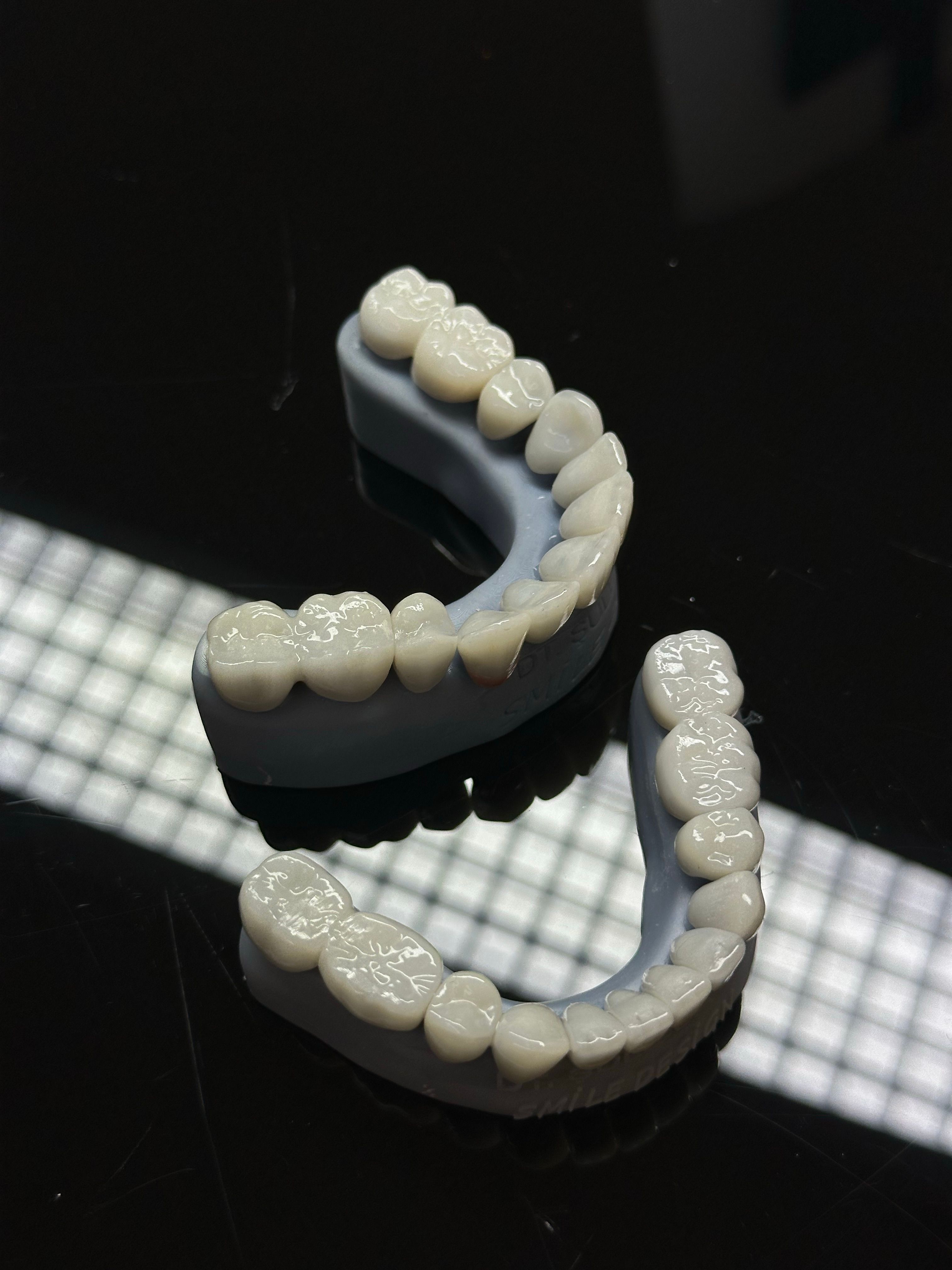 Коррекция формы зубов керамическими винирами